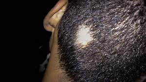 Round or inconsistent uncovered spots hairfall