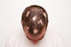 Patches that spread over the scalp and create hairfall